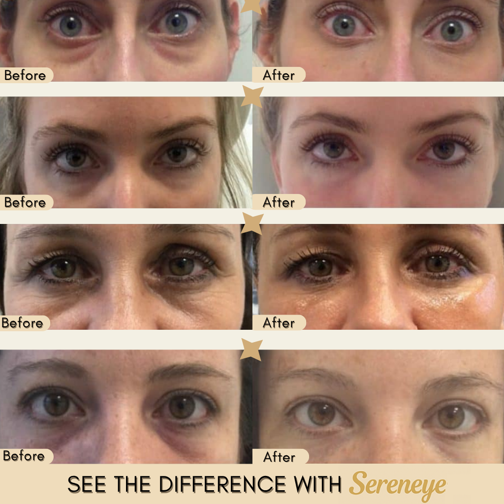 Sereneye – Smart Heating Eye Massager